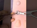 Cyst Removal Surgery