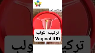 تركيب اللولب في الرحم                              دندنها