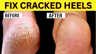 Remedies for CRACKED HEELS | Magical Cracked Heel Remedies |  एड़ियां फटना | Fix Cracked Heels