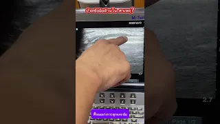  อาการเจ็บข้อมือเวลาบิดมีสาเหตุมาจากอะไร 