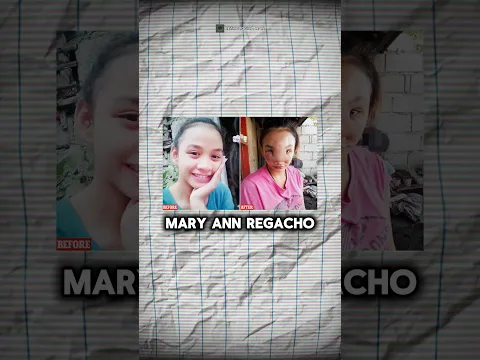 Pencet Jerawat Berujung Kebutaan : Mary Ann Regacho #lethologicaman