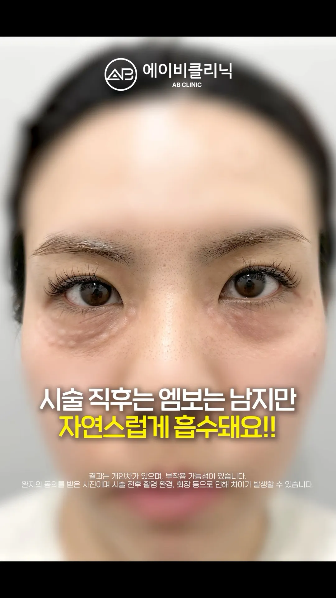 자글자글 칙칙한 눈밑, 리쥬란아이로 해결 💗