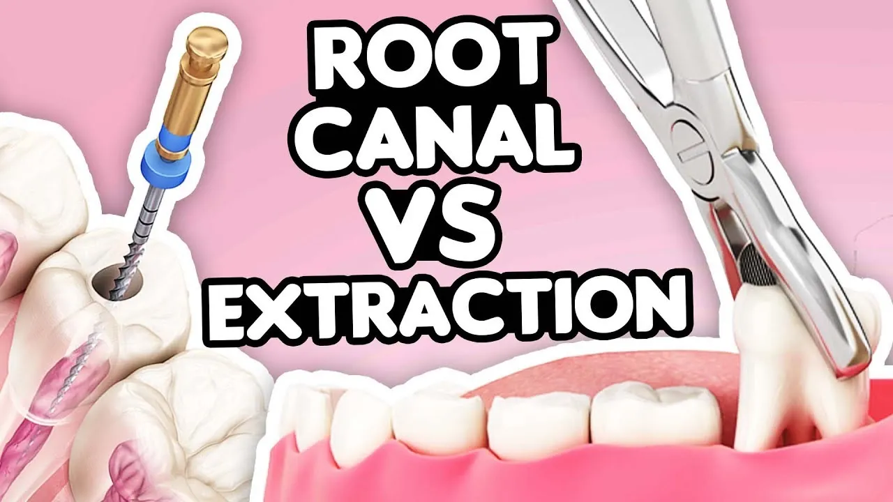 Outline Video Root Canal vs. Tooth Extraction: What’s the Right Choice?