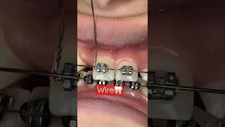 Orthodontic Treatment Fixed Braces Ligature Power Chain OrthoDentistry