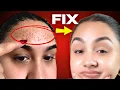 Tiny Bumps in Summer 2 Pharmacy Fix for Fungal Acne That Works