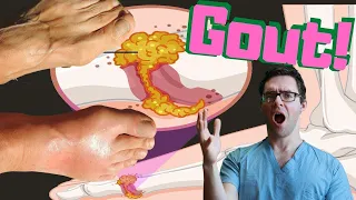 Download Gout ATTACK \u0026 Gout Big Toe Joint TREATMENT [Gout FOOT Treatment] MP3