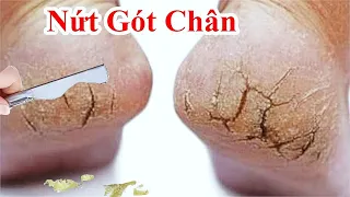Hướng dân cách trị nứt gót chân tại nhà hiệu quả nhất !