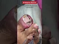 Download Lagu SUPER INFECTED INGROWN TOENAIL😳#shorts #ingrown_toenail