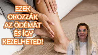 Ezek okozzák az ödémát! Így szabadulj meg tőle!