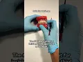 Maxillary Third Molar Incisions OnlineExodontia com
