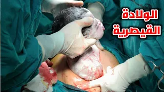 شاهد الولادة القيصرية من البداية لنهاية Cesarean Section 