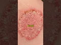 Download Lagu One Common Mistake Fungal Infection | Dr. Deepika Lunawat
