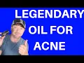 How I Use Tea Tree Oil For Acne