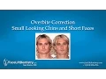 Overbite Correction - Small Looking Chins and Short Faces