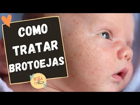 Download MP3 Brotoejas em Bebê: Como Tratar (DICAS INCRÍVEIS)