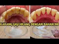 Download Lagu 4 CARA EFEKTIF MEMBERSIHKAN KARANG GIGI SECARA AMAN DAN ALAMI