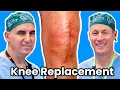 What To Expect Before A Total Knee Replacement