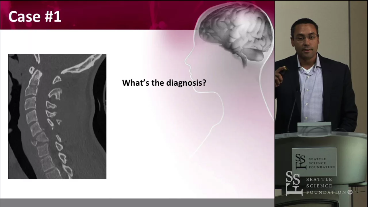 Management of Giant Calcified Thoracic Disc Herniations - Juan Uribe, MD. 