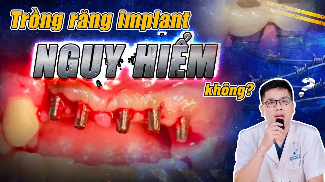 Outline Video Trồng Răng Implant Có Nguy Hiểm Không? 4 Nguy Hiểm Rình Rập Mà Ai Cũng Có Thể Gặp Phải