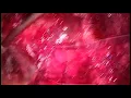 Download Lagu The Konno Procedure for a Redo Aortic Root Abscess
