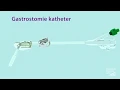 Lagu Gastrostomiekatheter - Ziekenhuis Gelderse Vallei