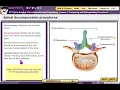 HCGTV Demo - Decompression and Corpectomy