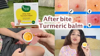 After bite turmeric balm for mosquito & insect bite for kids #afterbitebalm
