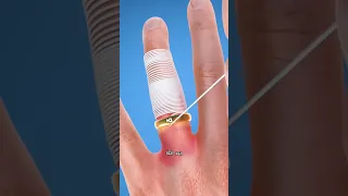 طريقة ذكية لإزالة الخاتم العالق بدون ألم دندنها