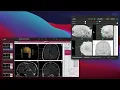 MNE-Python Intracranial Electrode Location Tutorial