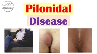 Pilonidal Disease (Cysts, Sinuses & Abscesses) | Causes, Symptoms, Diagnosis, Treatment
