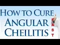 How To Cure Angular Cheilitis Symptoms With Angular Cheilitis Cream Treatment