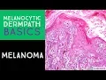 Melanocytic Dermpath Basics Melanoma