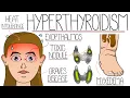 Understanding Hyperthyroidism Including Grave s Disease
