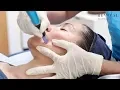 Micro-needling Full Training