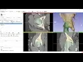 Femur segmentation using masked region growing in 3D Slicer