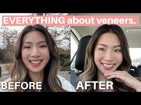 Download MP3 Everything to know about veneers | cost, pain, recovery