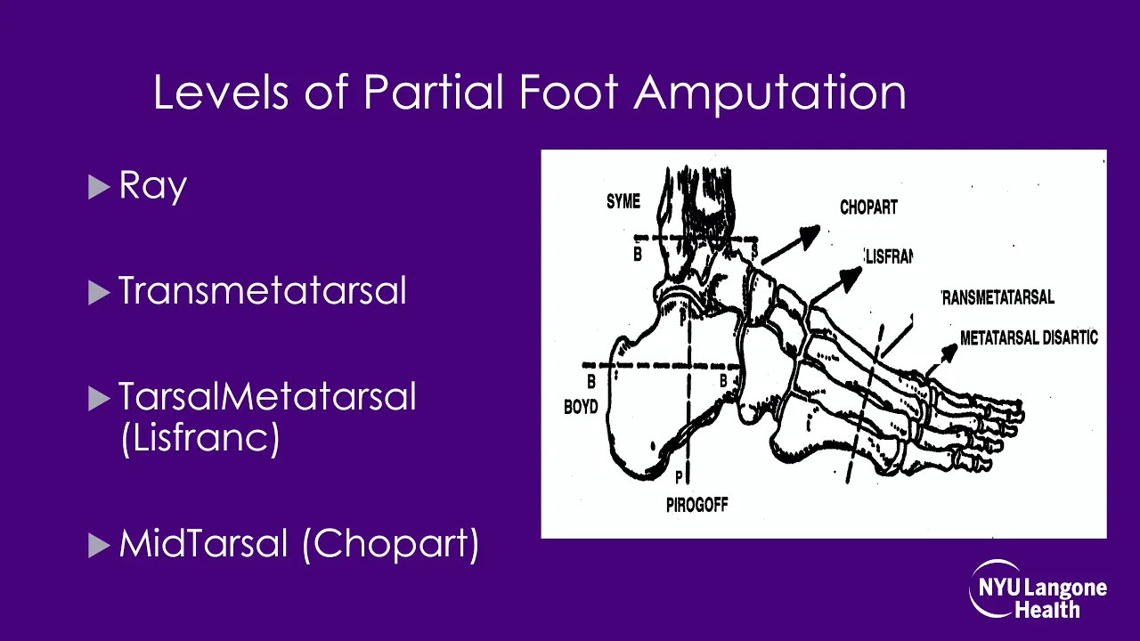 Lower Limb Orthotics and Prosthetics - ABOS Orthopedic Surgery Board Exam Review