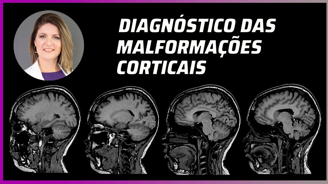 MALFORMAÇÕES CORTICAIS : EXAME DE RESSONÂNCIA E DIAGNÓSTICO