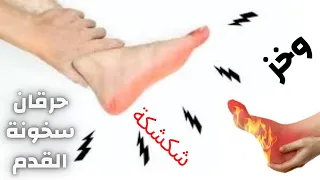 اسباب حرقان وسخونة القدم   حرقان ووخز في القدم   اسباب سخونية القدم   دكتور احمد حسن جمعه دندنها