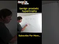 Everything you want to know about benign prostatic hypertrophy BPH