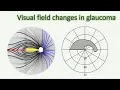 Visual field changes in glaucoma