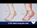 Download Lagu #322. Bệnh sưng phù chân: các lý do và cách chữa trị