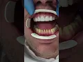 Download Lagu Before and After Zirconium Crowns
