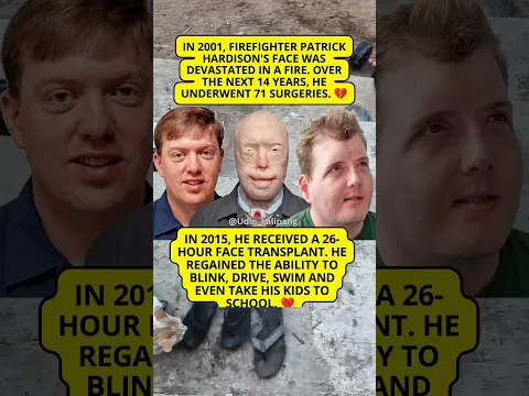 The Unbelievable 71-Surgery Comeback! #patrickhardison #facetransplant #firefighter #medicalmiracle