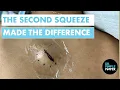 The Second Squeeze Made The Difference Epidermoid Cyst Removal