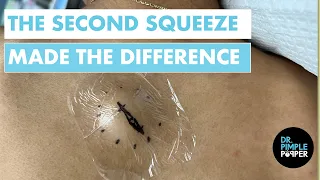 The Second Squeeze Made The Difference Epidermoid Cyst Removal