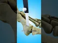 Download Lagu How Bunion Surgery Can Transform Your Foot Health 😲 #shorts #viralvideo - Creativelearning3d