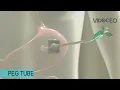 Percutaneous Endoscopic Gastrostomy PEG feeding tube animated explanation