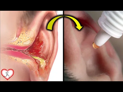 Download MP3 6 Mejores remedios caseros para la otitis externa o infección del oído