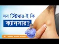 Does all Tumours lead to Cancer Dactar Babu Best Oncologists in Kolkata